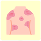 psoriazis_85